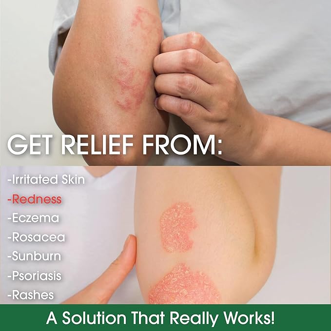 Manuka Honey Eczema Cream Moisturizing Lotion For Psoriasis Relief - Itchy, Dry Skin Rash Ointment -Skin Soothing Moisturizer Baby Kids & Adults-High Strength Body & Face Cream 16oz