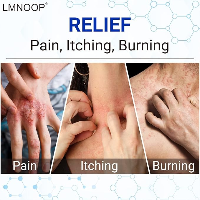 LMNOOP® Eczema Cream, Maximum Strength Treatment Ointment for Dermatitis, Rash, Psoriasis, Urticaria, Tinea Pedis, Fungal Infection, Anti-Itch, Relief for Sensitive & Irritated Skin, 1.76oz 2PCS